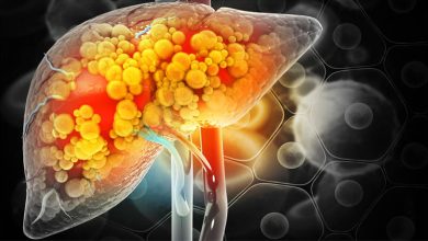 مرض الكبد الدهني