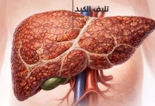 تليف الكبد