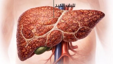 تليف الكبد
